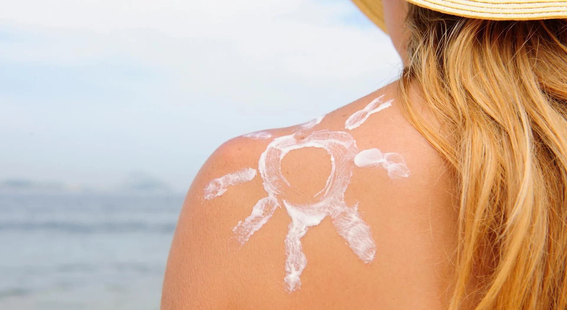 5 natürliche Heilmittel gegen Sonnenbrand